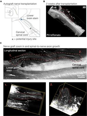 Advancing Peripheral Nerve Graft Transplantation for Incomplete Spinal Cord Injury Repair